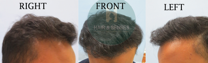 2500 Scalp Grafts Result